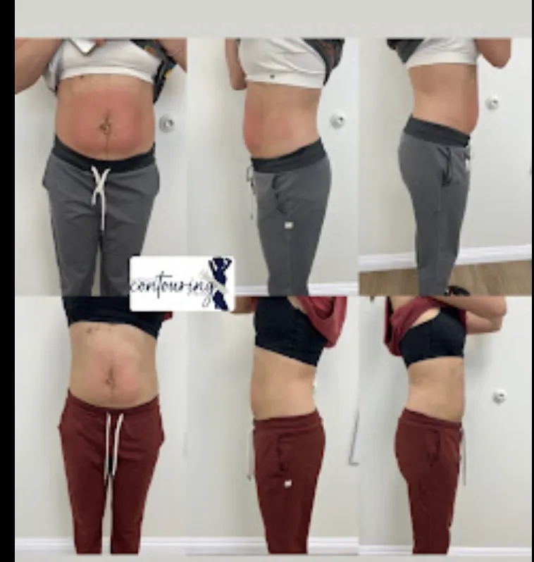 IV therapy at Aesthetic Contouring By Mina in Santa Ana CA