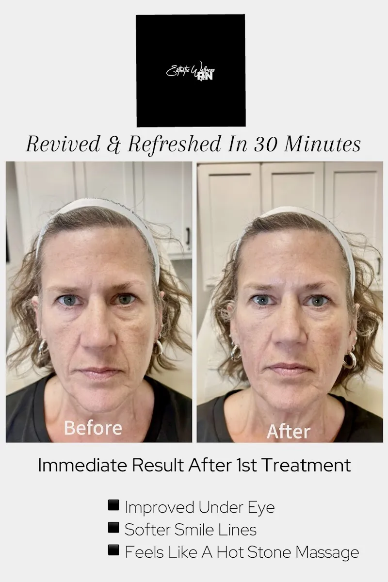IV therapy at Esthetic Wellness Med Spa in Irving TX